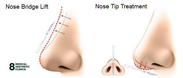 Nose Threadlifts